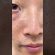 ニキビ消すならコレが1番❗️まだ使ってない人は絶対試してみて！#メンズ美容 #垢抜け #おすすめ #ニキビ #ニキビケア #pr